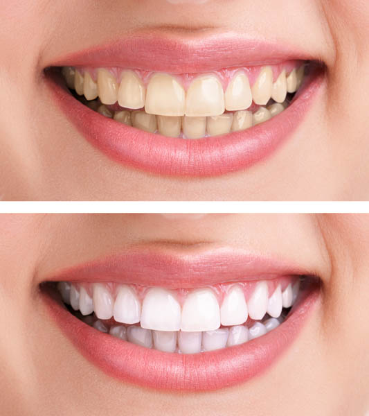 teeth whitening example case