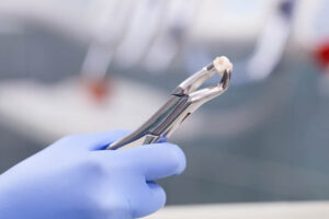 Root canals and extractions, procedure